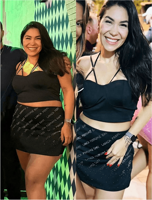 Antes e depois de cliente que usa Tizerpatida